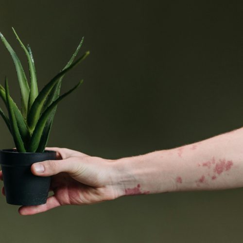 Eczema Vs. Dermatitis